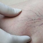Yaz sıcakları varisleri tetikliyor